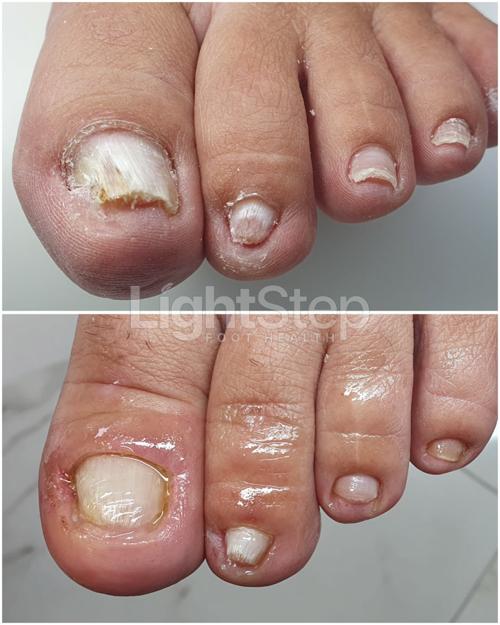 Fungal nail treatment after - LightStep Loughborough